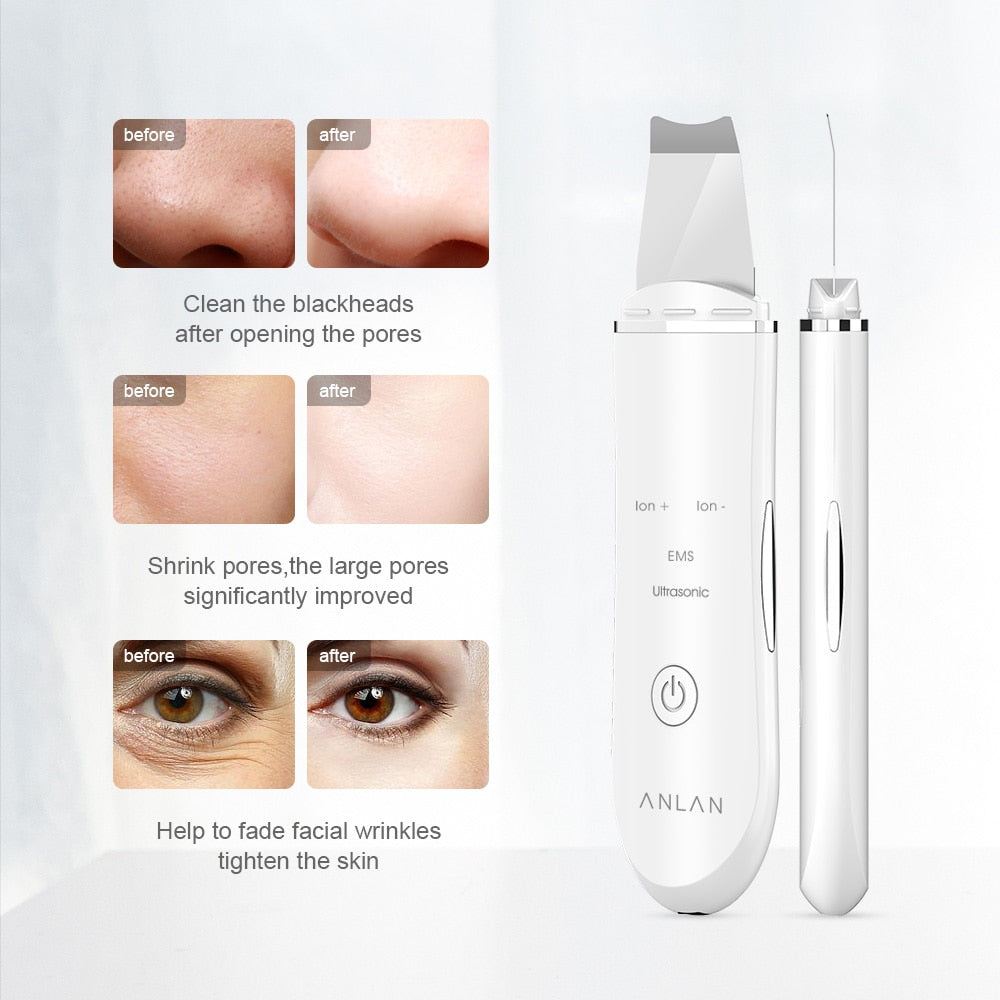 SkinSculpt™ Ultrasonic Skin Scrubber Lift Machine